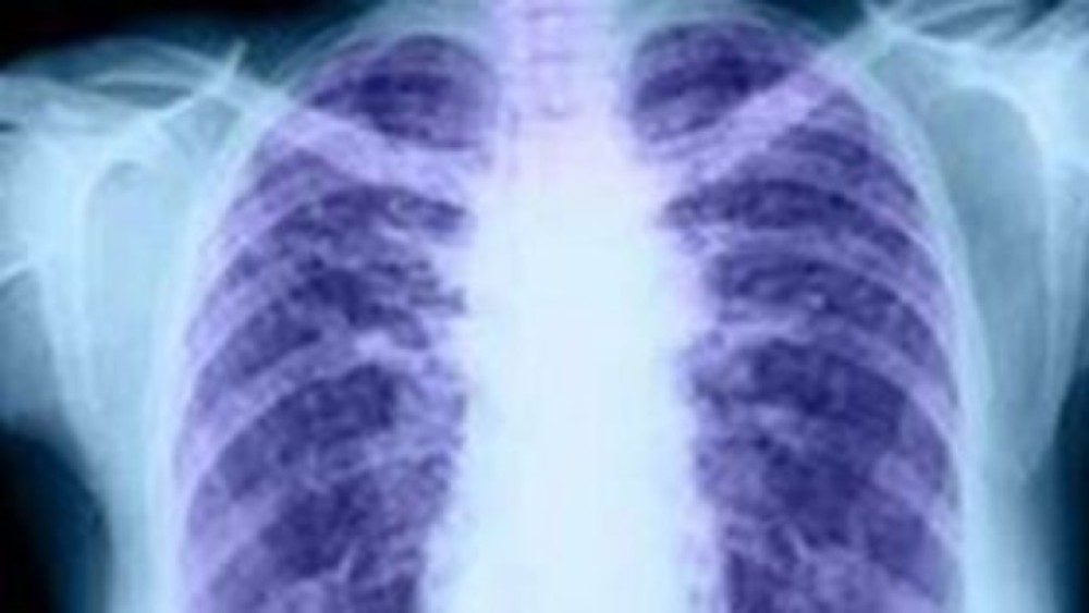 Γιατρός για κορωνοϊό: Στις σοβαρότερες μορφές οι πνεύμονες αντί για αέρα γεμίζουν με «υγρό»