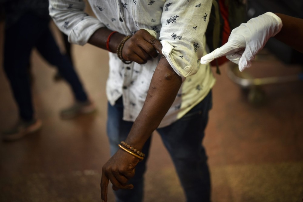 Ευλογιά των πιθήκων: Θάνατος για την Αφρική, τα εμβόλια είναι για άλλους